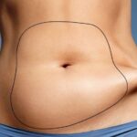 How to lose weight after Liposuction? Weight loss after liposuction